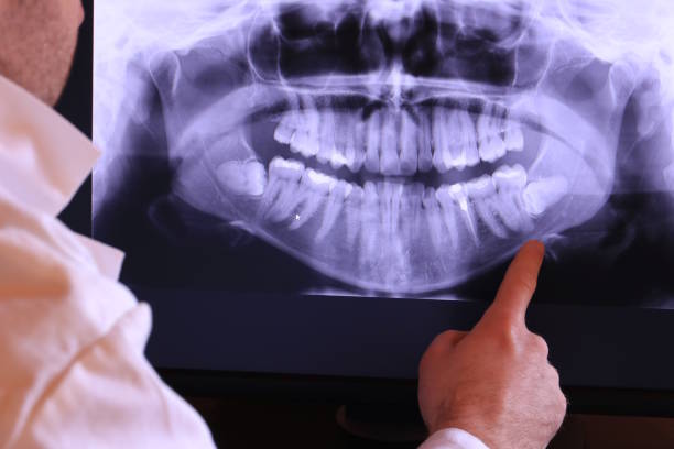 Best Emergency Root Canal Treatment in Hobart, IN